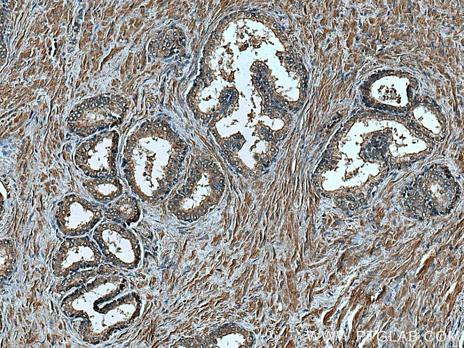 IHC staining of human prostate hyperplasia using 67344-1-Ig