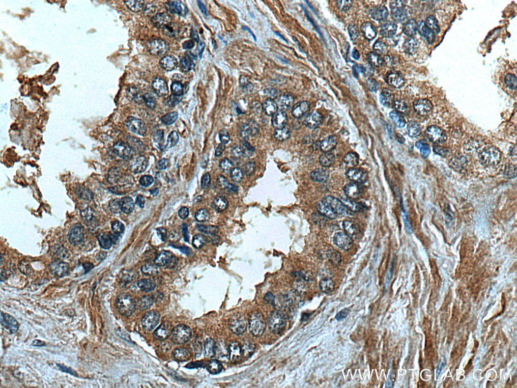 IHC staining of human prostate hyperplasia using 67344-1-Ig