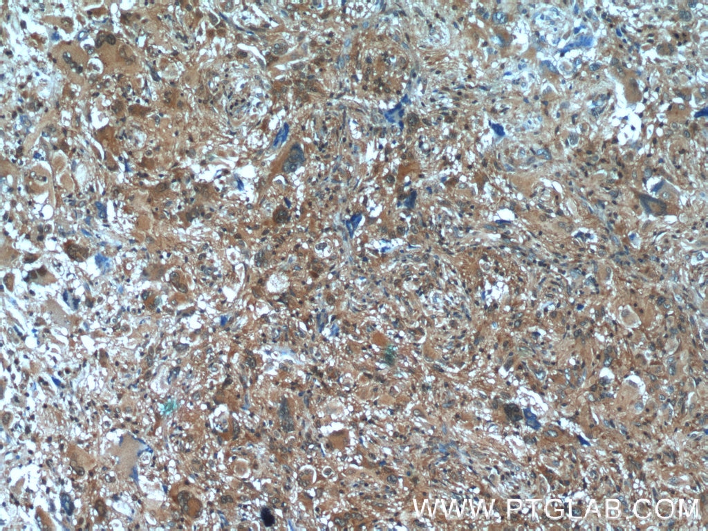 IHC staining of human gliomas using 19497-1-AP