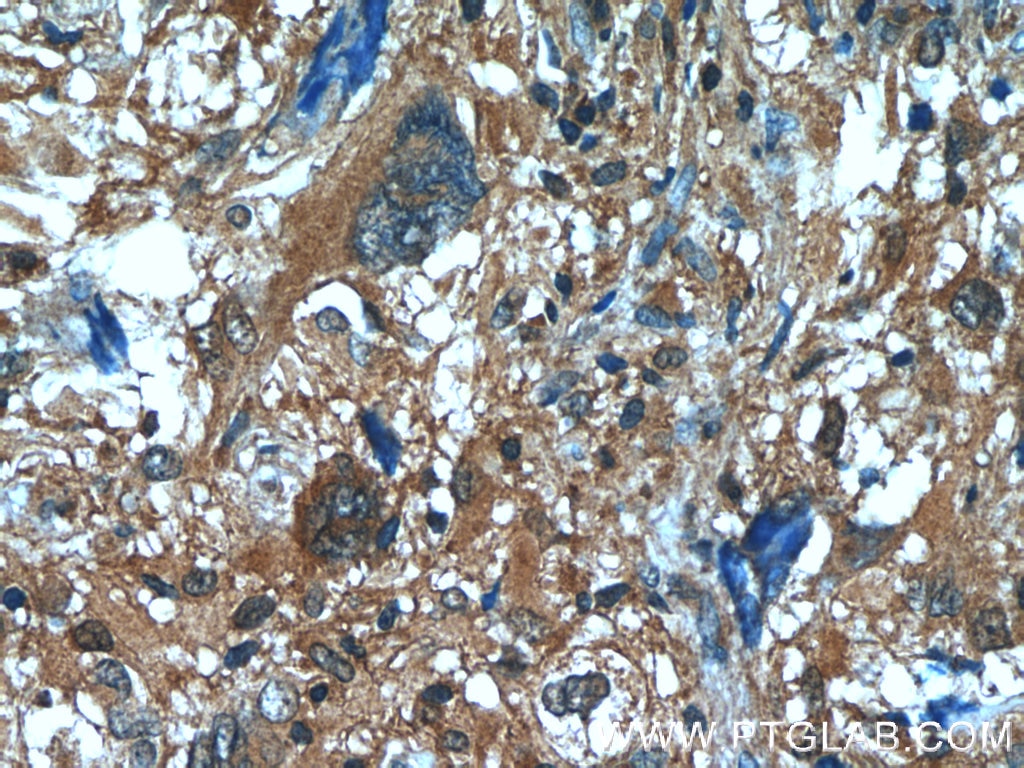 IHC staining of human gliomas using 19497-1-AP