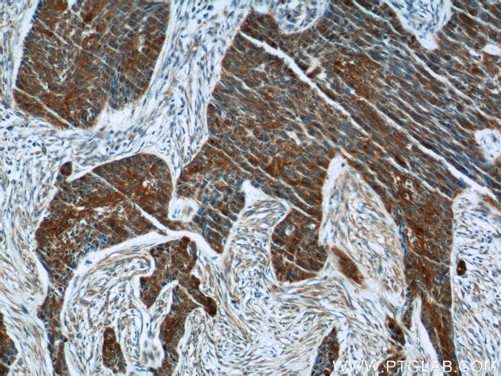 Immunohistochemistry (IHC) staining of human skin cancer tissue using FUT4 Polyclonal antibody (19497-1-AP)