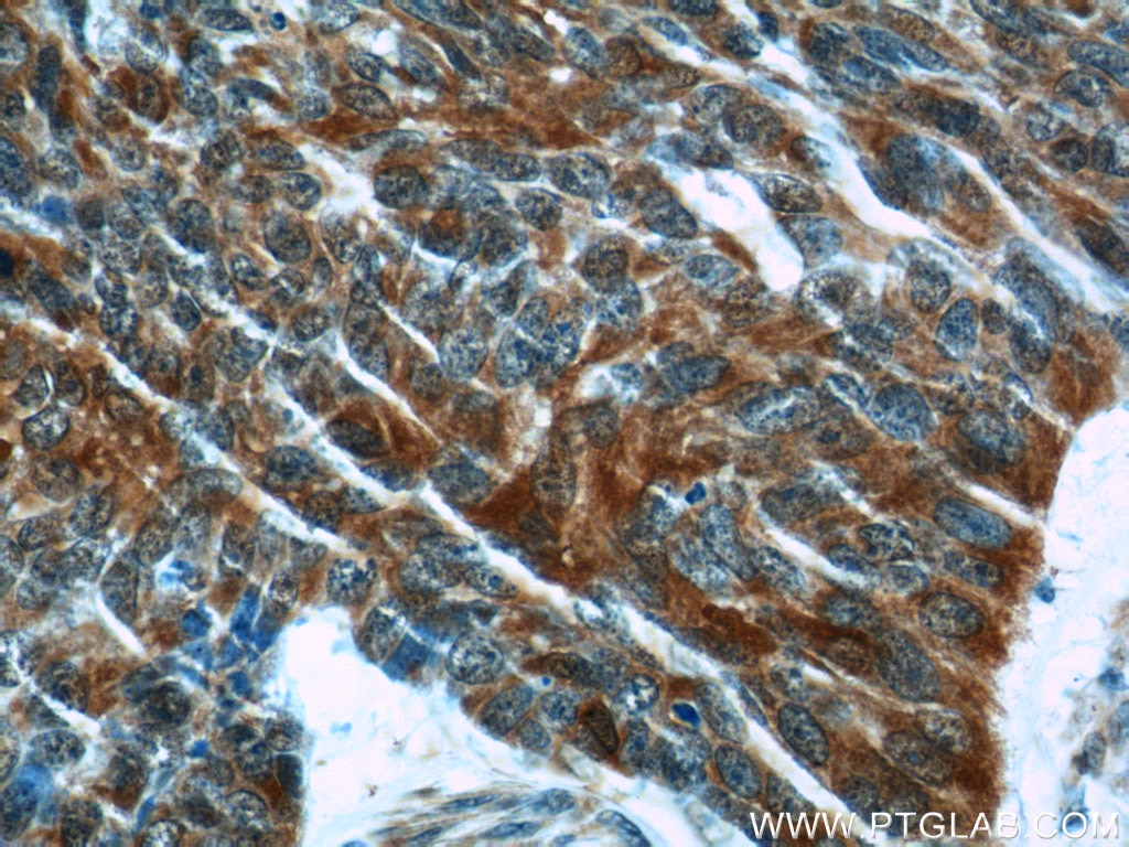 IHC staining of human skin cancer using 19497-1-AP