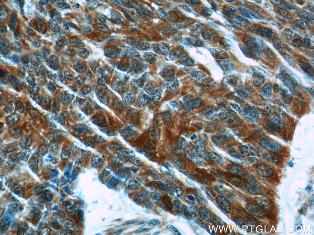 Immunohistochemistry (IHC) staining of human skin cancer tissue using FUT4 Polyclonal antibody (19497-1-AP)