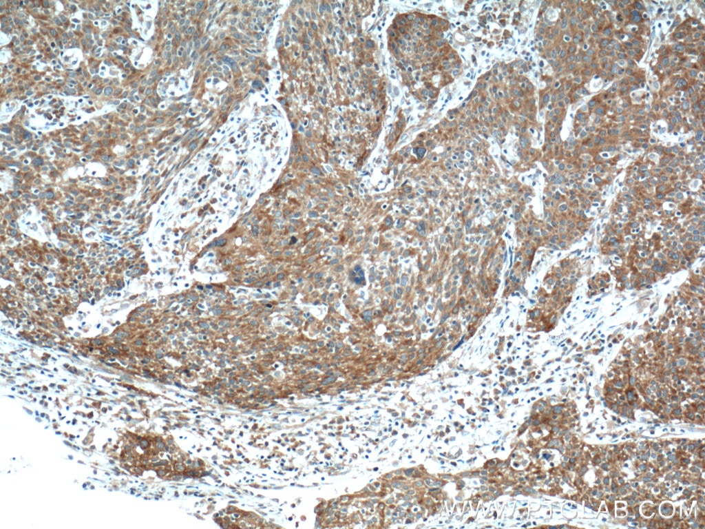 Immunohistochemistry (IHC) staining of human lung cancer tissue using FUT4 Polyclonal antibody (19497-1-AP)