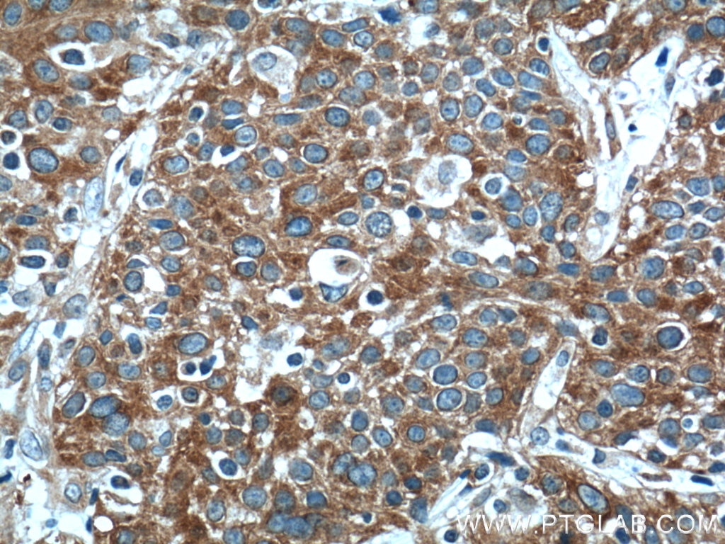 Immunohistochemistry (IHC) staining of human lung cancer tissue using FUT4 Polyclonal antibody (19497-1-AP)