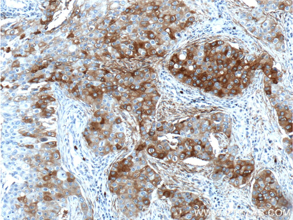 Immunohistochemistry (IHC) staining of human breast cancer tissue using FUT4 Polyclonal antibody (22141-1-AP)