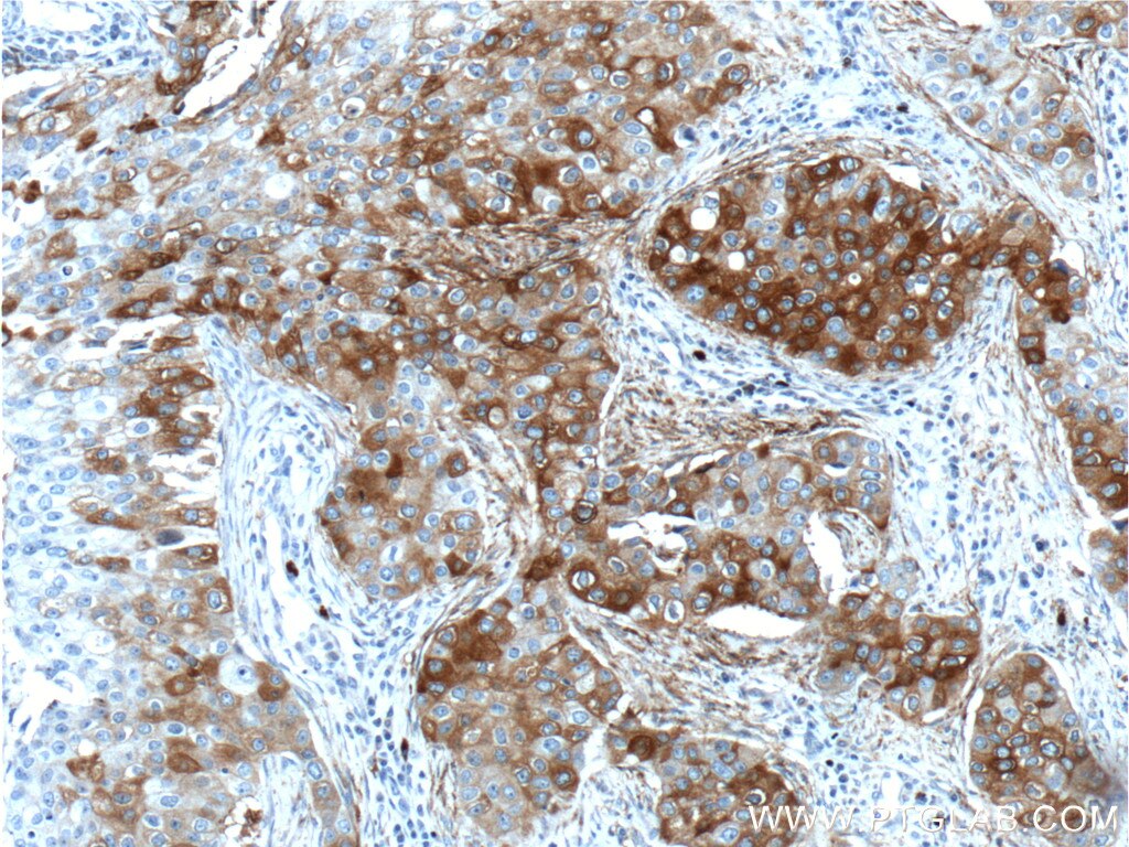 IHC staining of human breast cancer using 22141-1-AP