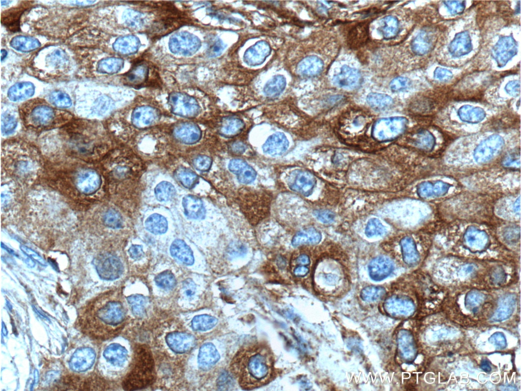 Immunohistochemistry (IHC) staining of human breast cancer tissue using FUT4 Polyclonal antibody (22141-1-AP)