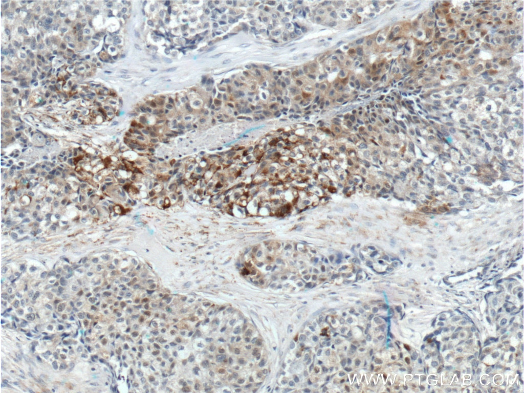Immunohistochemistry (IHC) staining of human lung cancer tissue using FUT4 Polyclonal antibody (22141-1-AP)