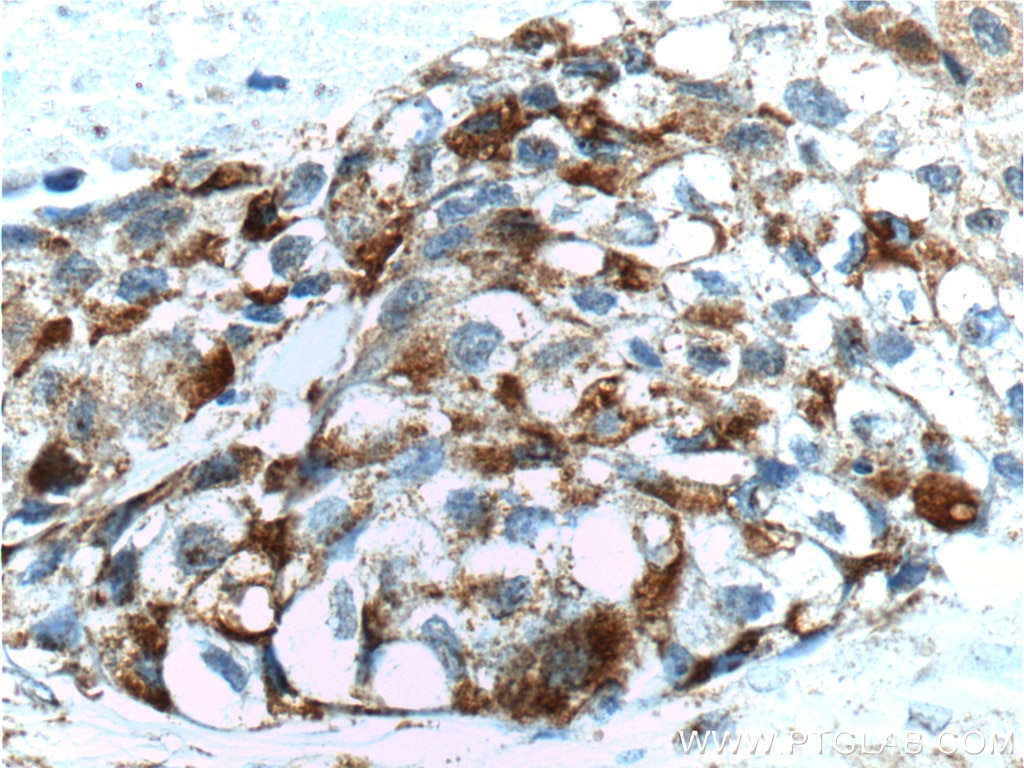 Immunohistochemistry (IHC) staining of human lung cancer tissue using FUT4 Polyclonal antibody (22141-1-AP)