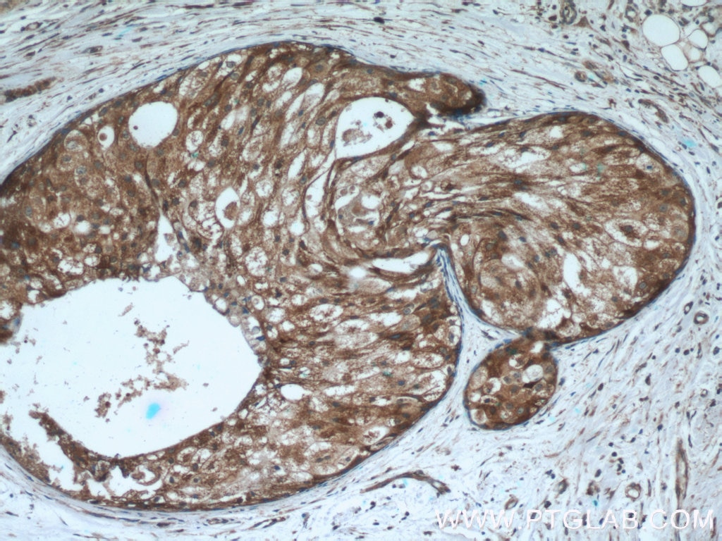 Immunohistochemistry (IHC) staining of human breast cancer tissue using FUT7 Polyclonal antibody (18197-1-AP)