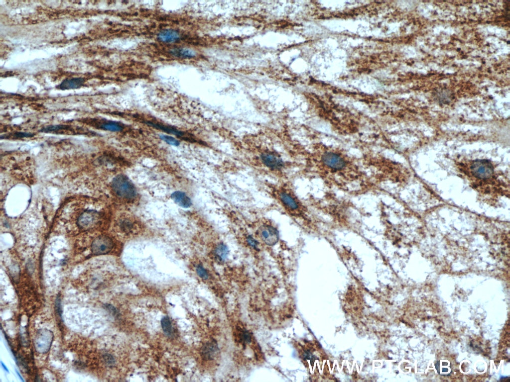 Immunohistochemistry (IHC) staining of human breast cancer tissue using FUT7 Polyclonal antibody (18197-1-AP)