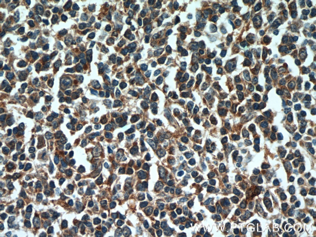 Immunohistochemistry (IHC) staining of human tonsillitis tissue using FUT7 Polyclonal antibody (18197-1-AP)