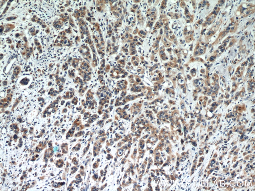 Immunohistochemistry (IHC) staining of human stomach cancer tissue using FUT8 Polyclonal antibody (12560-1-AP)