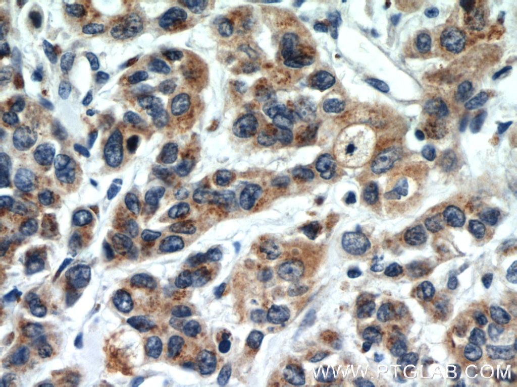 Immunohistochemistry (IHC) staining of human stomach cancer tissue using FUT8 Polyclonal antibody (12560-1-AP)