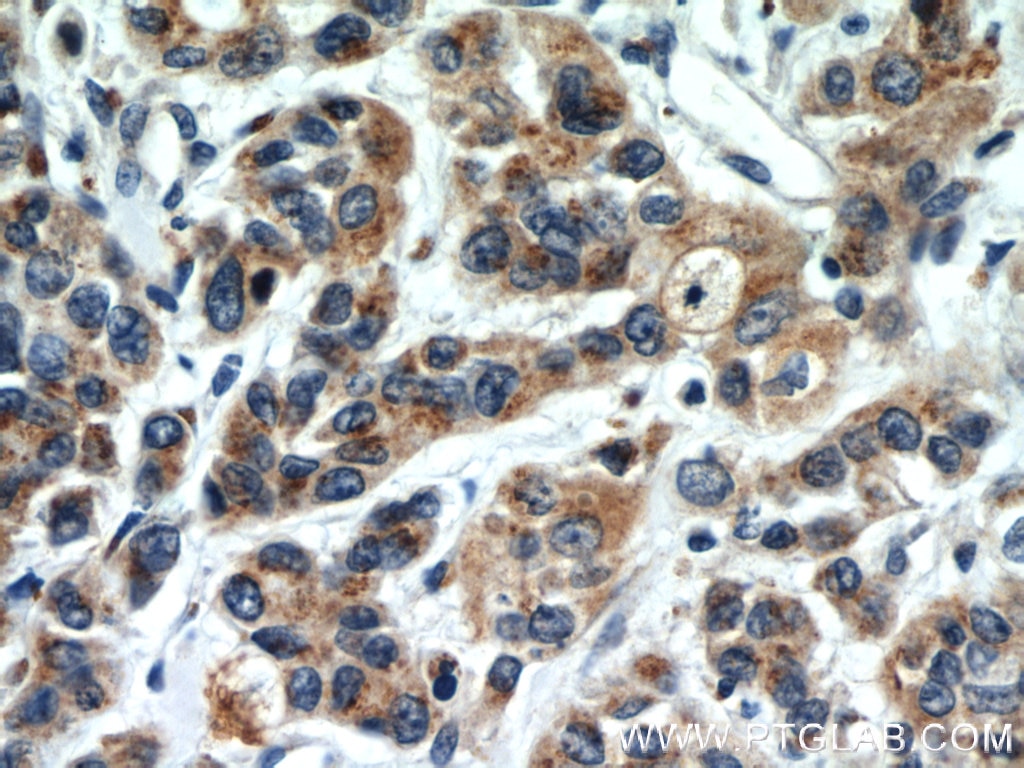 IHC staining of human stomach cancer using 12560-1-AP