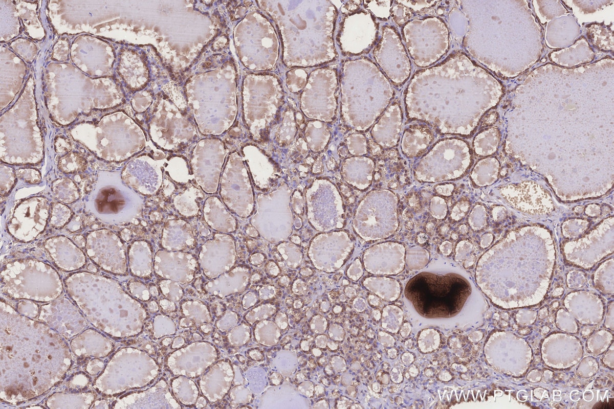 Immunohistochemistry (IHC) staining of human thyroid cancer tissue using FUT8 Polyclonal antibody (12560-1-AP)