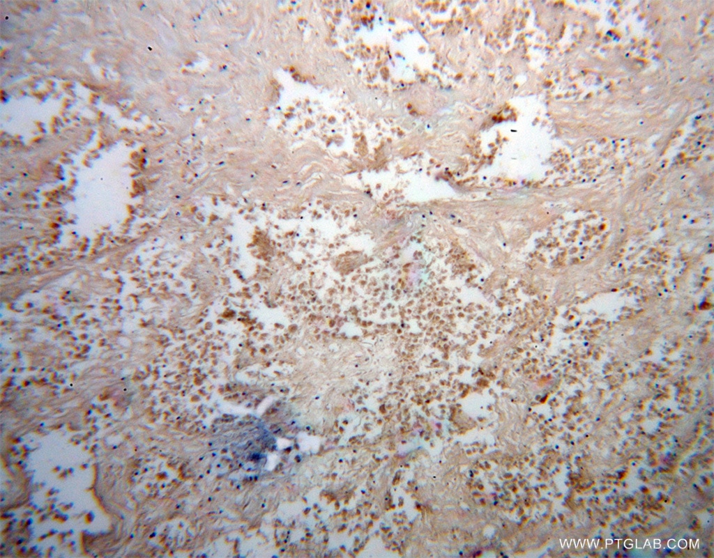 IHC staining of human lung cancer using 12560-1-AP