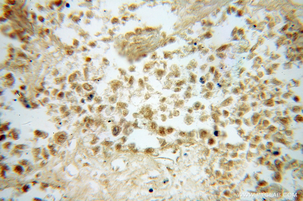 Immunohistochemistry (IHC) staining of human lung cancer tissue using FUT8 Polyclonal antibody (12560-1-AP)