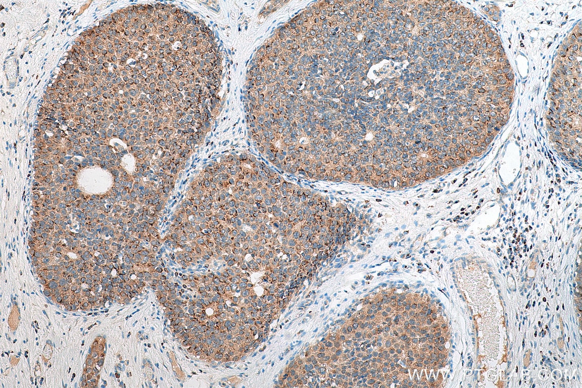 Immunohistochemistry (IHC) staining of human breast cancer tissue using FUT8 Polyclonal antibody (29430-1-AP)