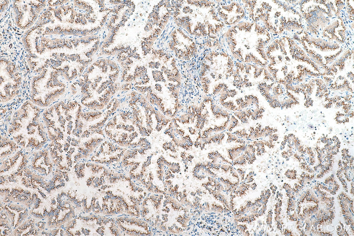 Immunohistochemistry (IHC) staining of human lung cancer tissue using FUT8 Polyclonal antibody (29430-1-AP)