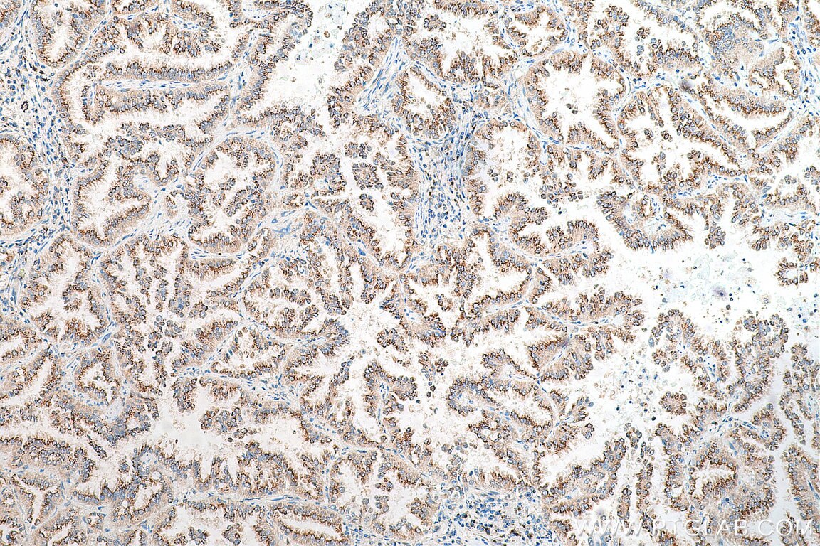 Immunohistochemistry (IHC) staining of human lung cancer tissue using FUT8 Polyclonal antibody (29430-1-AP)