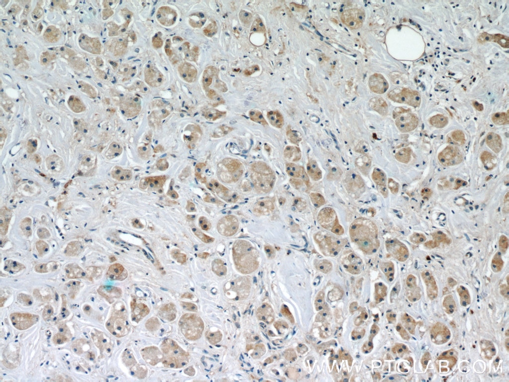 Immunohistochemistry (IHC) staining of human breast cancer tissue using FUT8 Monoclonal antibody (66118-1-Ig)