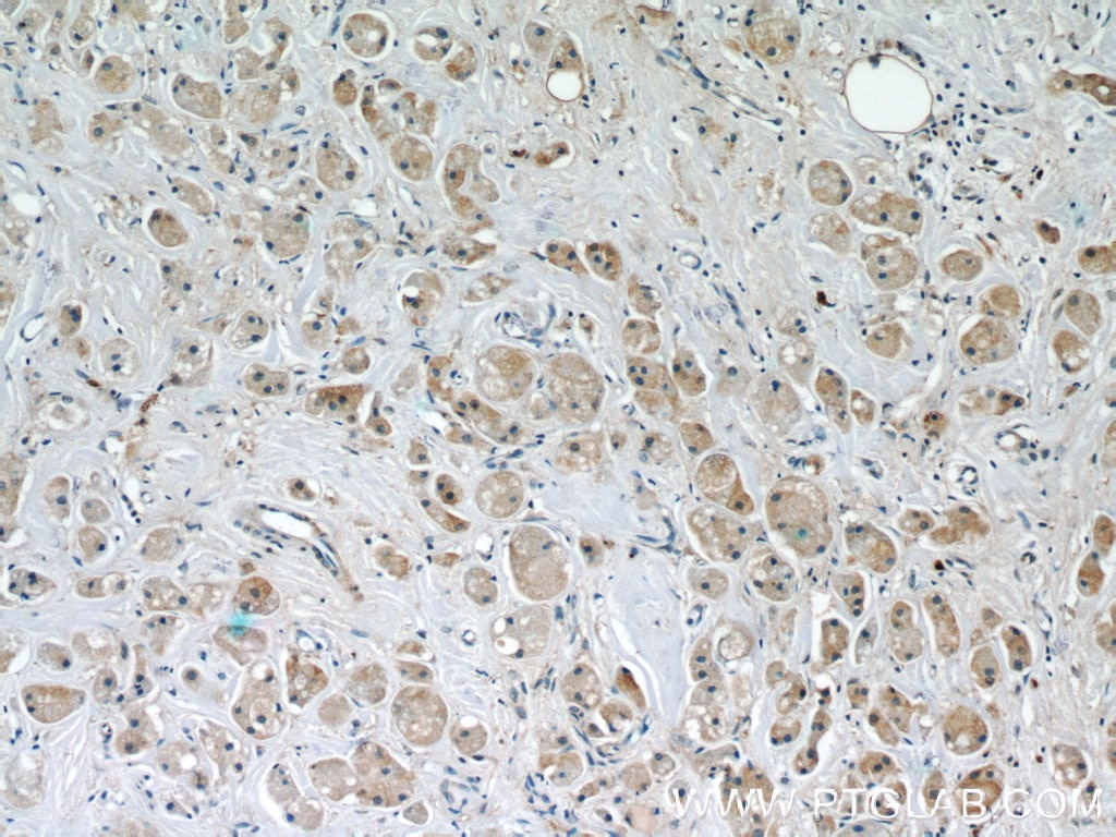 IHC staining of human breast cancer using 66118-1-Ig