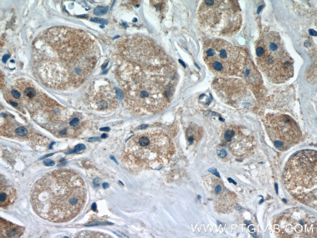 IHC staining of human breast cancer using 66118-1-Ig