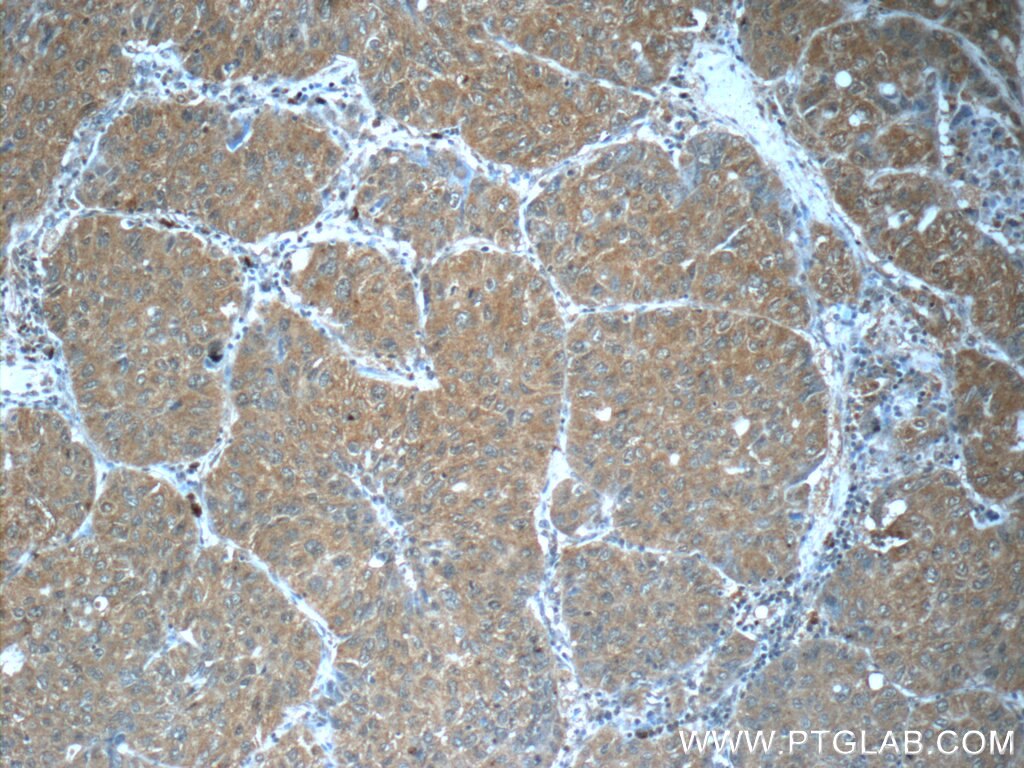 Immunohistochemistry (IHC) staining of human lung cancer tissue using FUT8 Monoclonal antibody (66118-1-Ig)