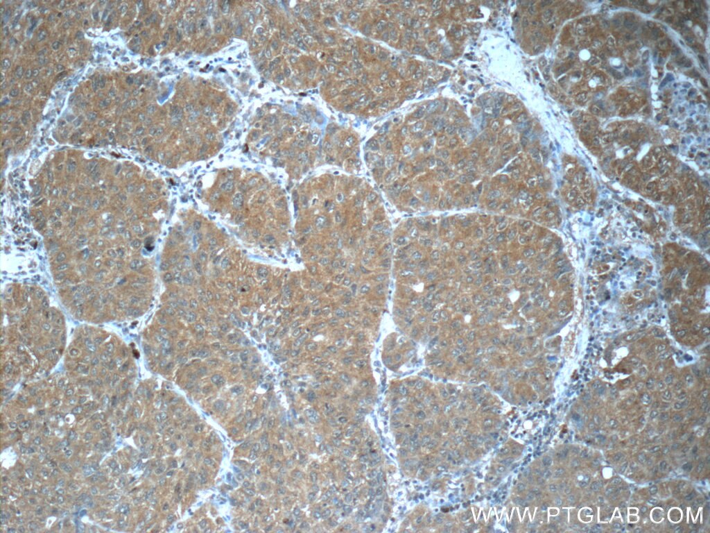 Immunohistochemistry (IHC) staining of human lung cancer tissue using FUT8 Monoclonal antibody (66118-1-Ig)