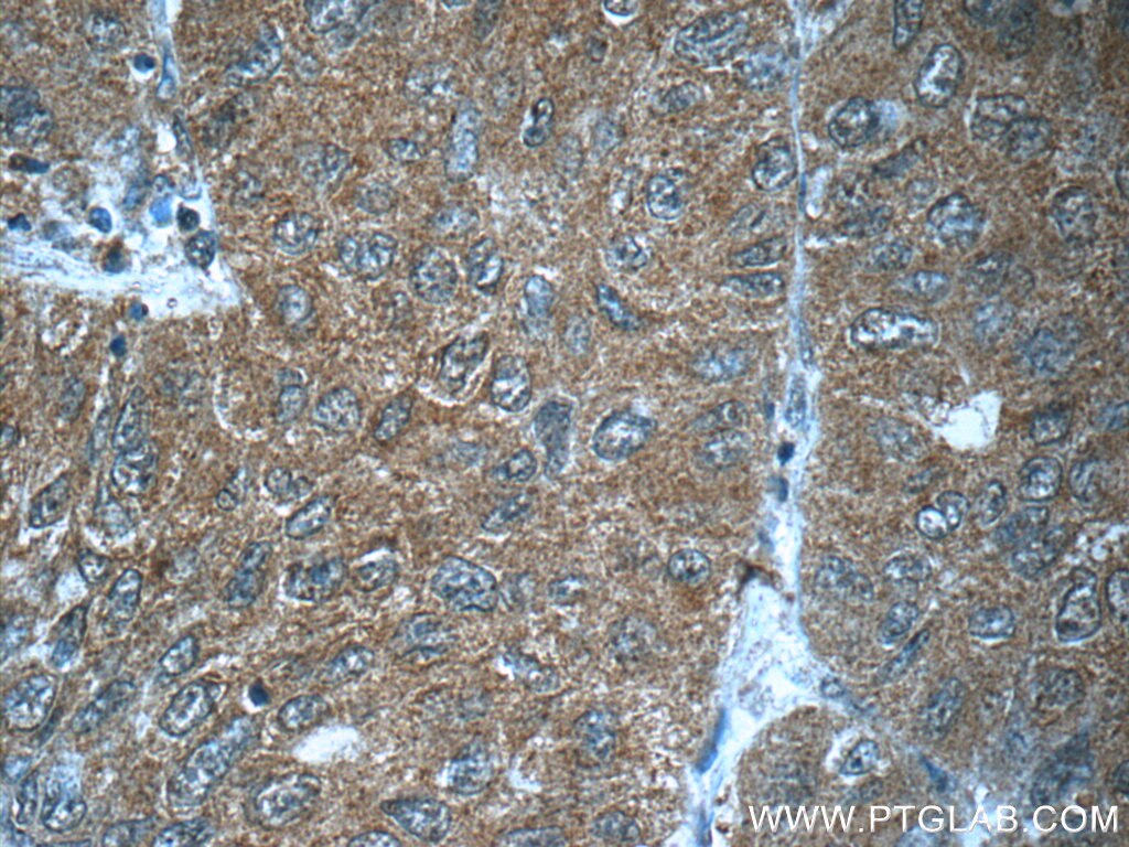 Immunohistochemistry (IHC) staining of human lung cancer tissue using FUT8 Monoclonal antibody (66118-1-Ig)