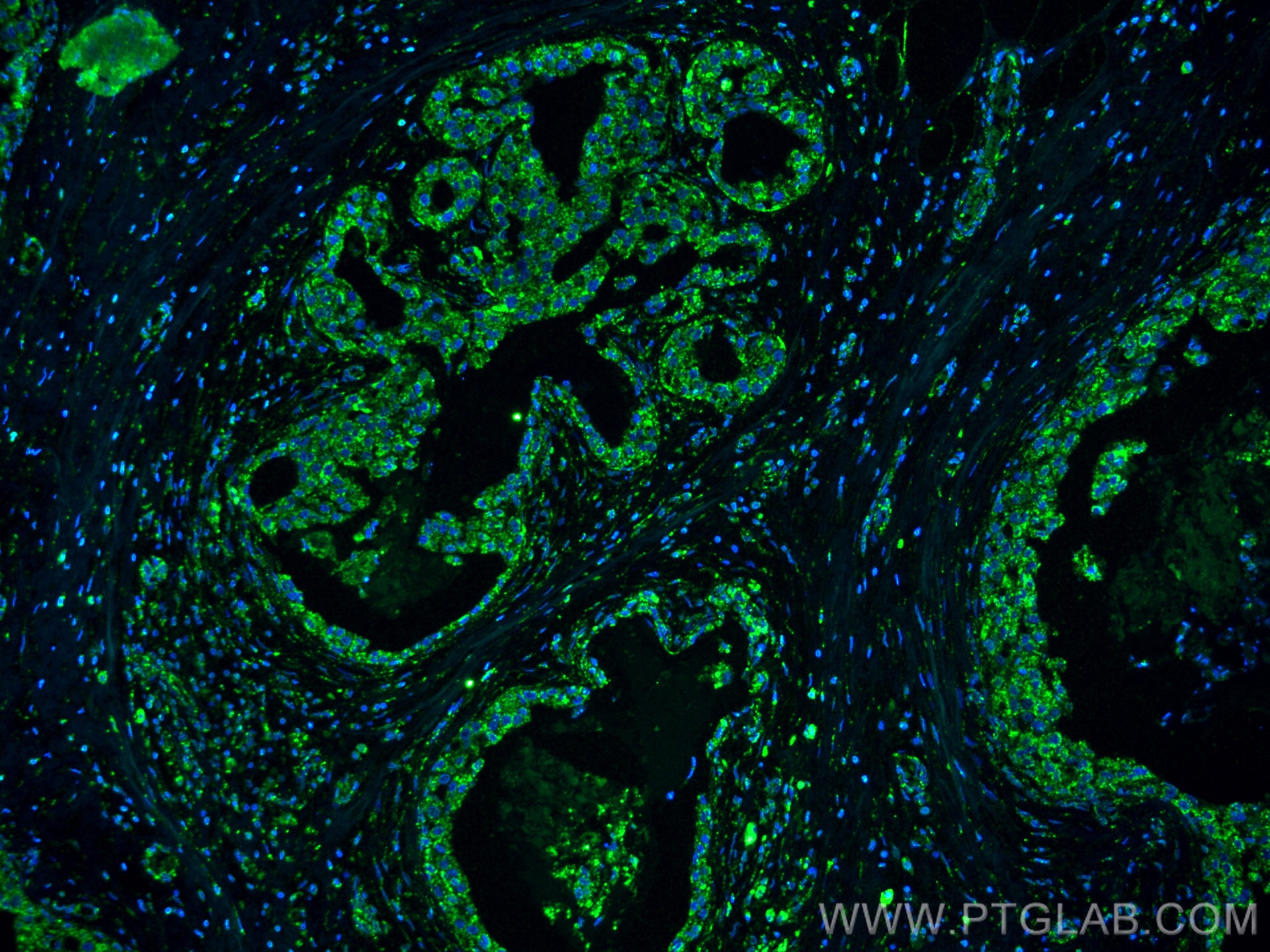 Immunofluorescence (IF) / fluorescent staining of human breast cancer tissue using FUT9 Monoclonal antibody (60230-1-Ig)