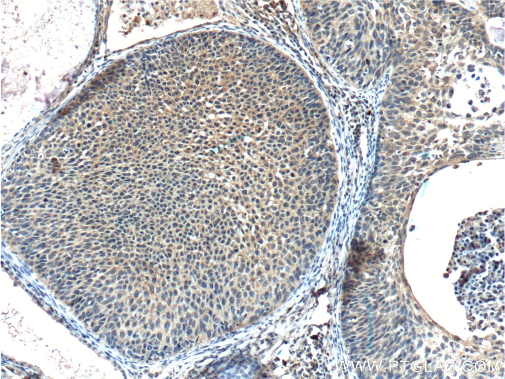 Immunohistochemistry (IHC) staining of human cervical cancer tissue using FUT9 Monoclonal antibody (60230-1-Ig)