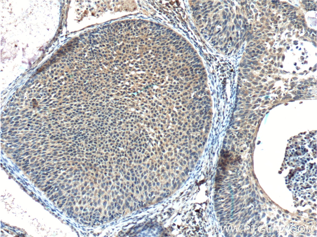 IHC staining of human cervical cancer using 60230-1-Ig