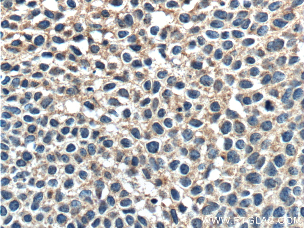 IHC staining of human cervical cancer using 60230-1-Ig
