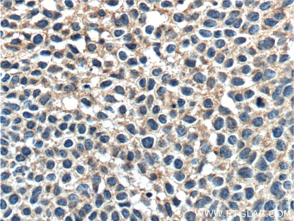 Immunohistochemistry (IHC) staining of human cervical cancer tissue using FUT9 Monoclonal antibody (60230-1-Ig)