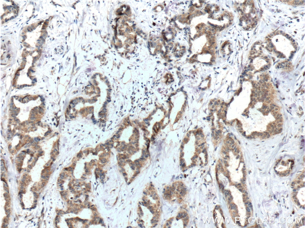 Immunohistochemistry (IHC) staining of human breast cancer tissue using FUT9 Monoclonal antibody (60230-1-Ig)