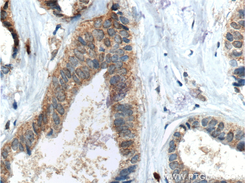Immunohistochemistry (IHC) staining of human breast cancer tissue using FUT9 Monoclonal antibody (60230-1-Ig)
