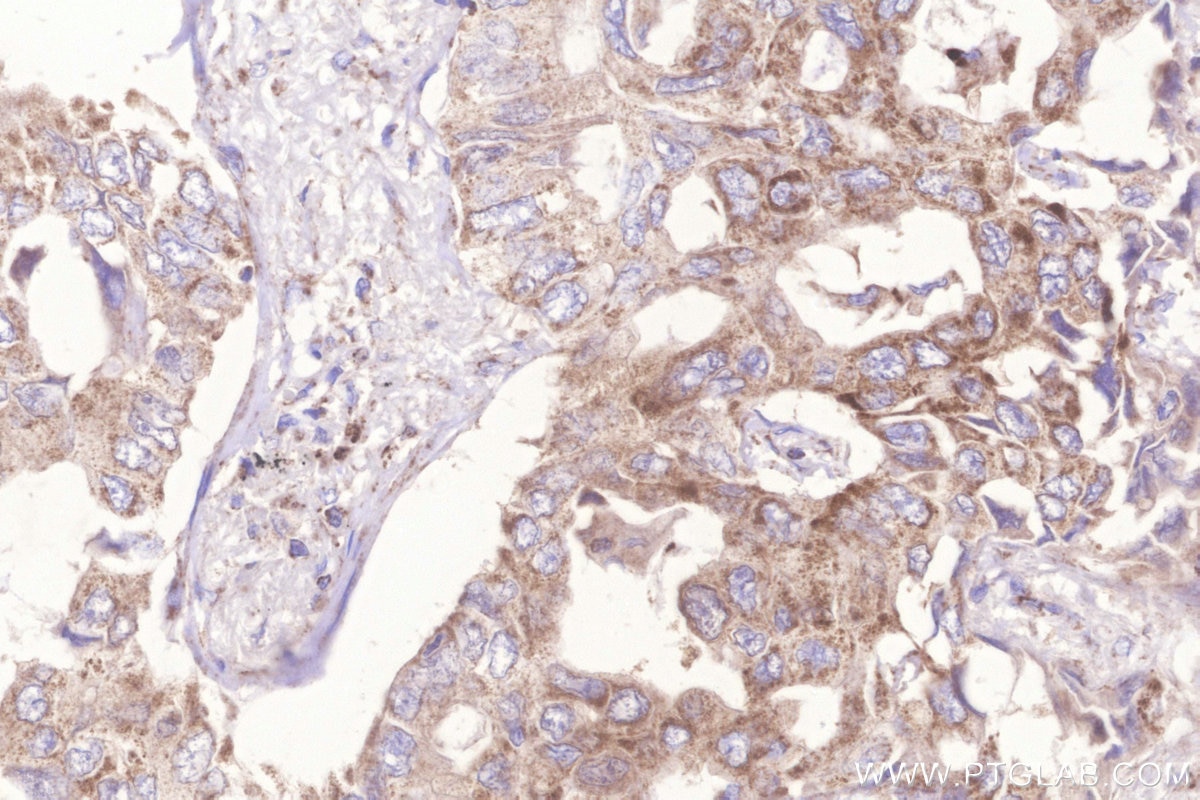 Immunohistochemistry (IHC) staining of human lung cancer tissue using Frataxin Polyclonal antibody (14147-1-AP)