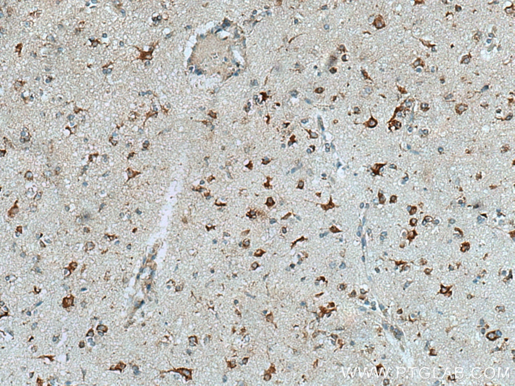 IHC staining of human gliomas using 67813-1-Ig