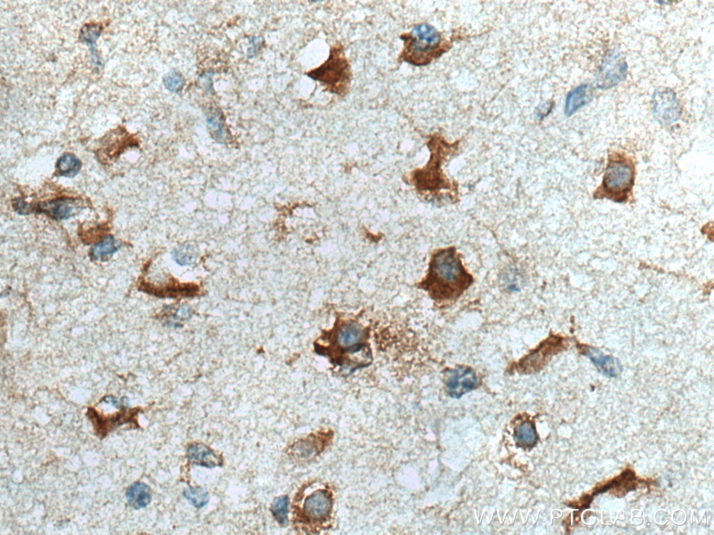 Immunohistochemistry (IHC) staining of human gliomas tissue using FXR1 Monoclonal antibody (67813-1-Ig)
