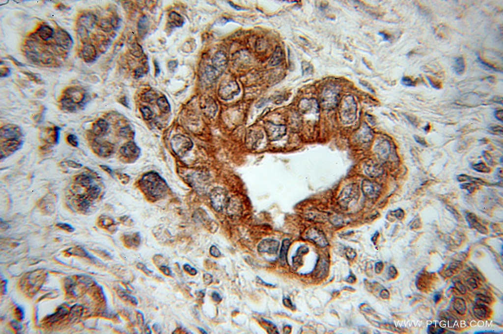 IHC staining of human pancreas cancer using 11198-1-AP
