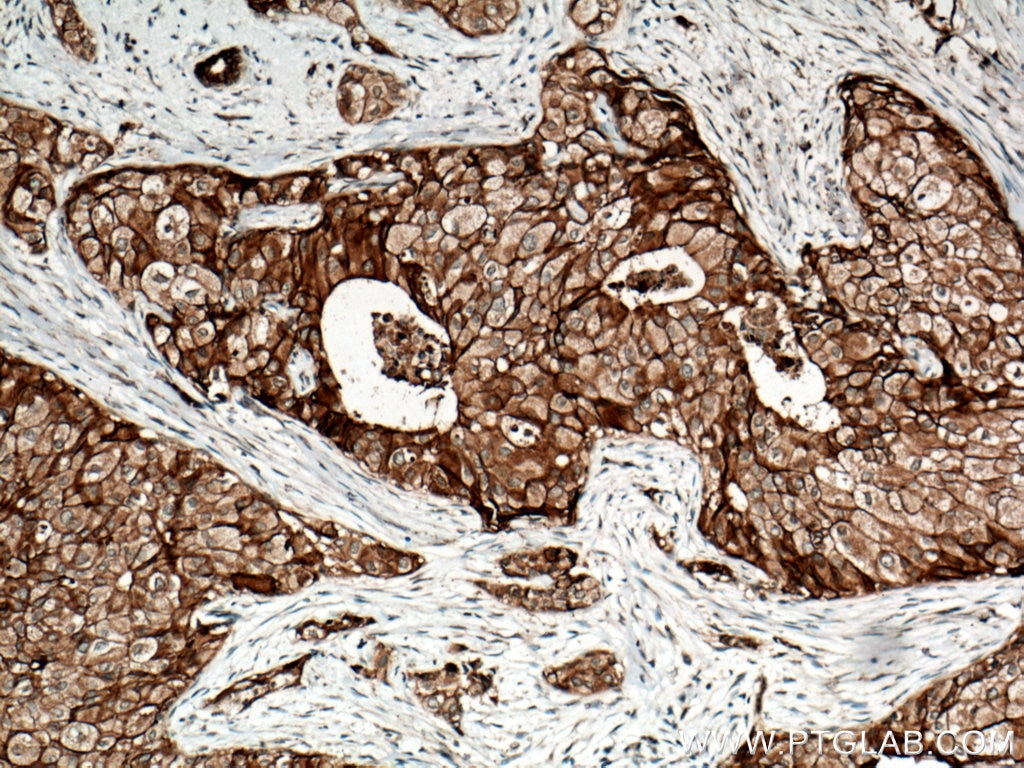Immunohistochemistry (IHC) staining of human breast cancer tissue using FXYD3 Polyclonal antibody (15853-1-AP)