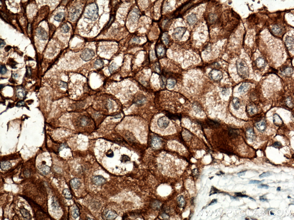 Immunohistochemistry (IHC) staining of human breast cancer tissue using FXYD3 Polyclonal antibody (15853-1-AP)