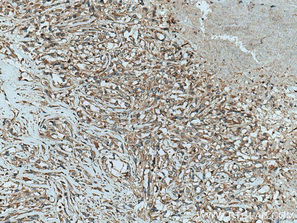 Immunohistochemistry (IHC) staining of human renal cell carcinoma tissue using FXYD4 Polyclonal antibody (11966-1-AP)