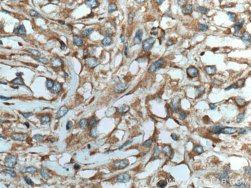 Immunohistochemistry (IHC) staining of human renal cell carcinoma tissue using FXYD4 Polyclonal antibody (11966-1-AP)