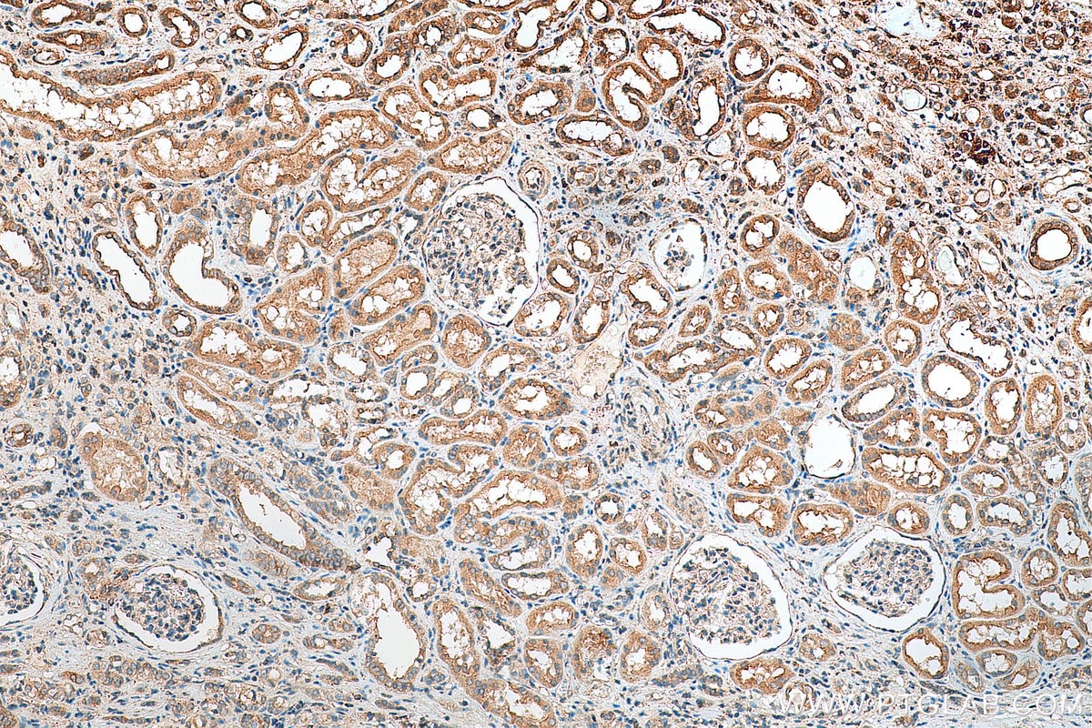 IHC staining of human renal cell carcinoma using 11966-1-AP