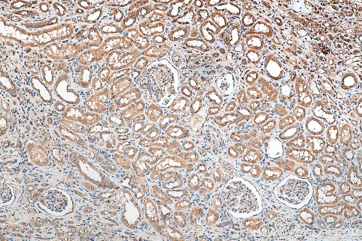 Immunohistochemistry (IHC) staining of human renal cell carcinoma tissue using FXYD4 Polyclonal antibody (11966-1-AP)