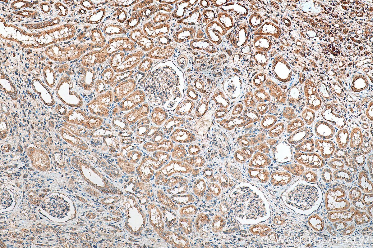 IHC staining of human renal cell carcinoma using 11966-1-AP